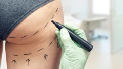 Close na região do glúteo de uma mulher com marcações feitas a caneta por um cirurgião