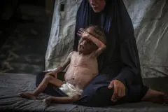 Una madre palestina junto a su hijo desnutrido en Gaza.