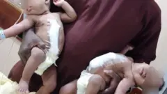 Kwara: Dókítà 66 ló síṣẹ́ abẹ fún àwọn ìbejì tó lẹ̀pọ̀ ní ilé ìwòdan fasiti Ilorin