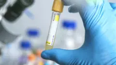 হেপাটাইটিস