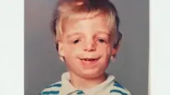 Jono Lancaster decak sa Tričer kolinsovim sindromom