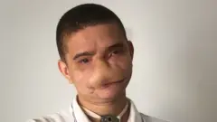 Samuel posa para una foto y muestra los impactos del accidente con fuego en su rostro