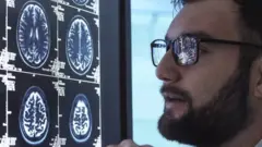 آلزایمر