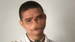 Samuel posa para una foto y muestra los impactos del accidente con fuego en su rostro