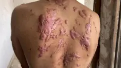 Costas de homem com grandes vergões inchados