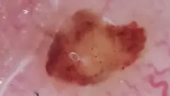 தோல் புற்றுநோய் ஏன் ஏற்படுகிறது? தடுப்பதற்கு என்ன வழி? மருத்துவர்கள் கூறுவது என்ன?