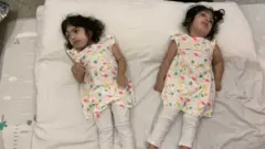 Siamesas após cirurgia de separação