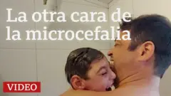 La otra cara de la microcefalia