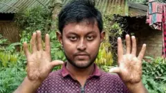 फिंगरप्रिंट, आजार