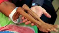 Tim Kesehatan mengatakan jumlah kematian terkait faktor yang berhubungan dengan makanan di Yaman mengalami peningkatan.