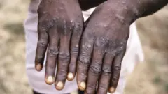 Monkeypox case