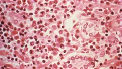 Estudo micrográfico de tecido hepático de um paciente com síndrome pulmonar por hantavírus (HPS)