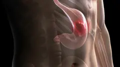 पेटको क्यान्सर