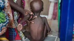 Malnutrition