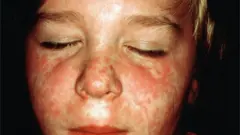 boy with measles