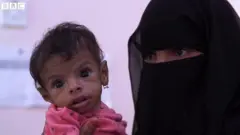 Une enfant souffrant de malnutrition au Yémen.