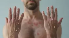 Homem com sintomas de varíola dos macacos
