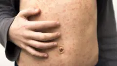 በኩፍኝ የተያዘ ሰው አካል