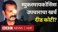 म्युकरमायकोसिस रुग्ण
