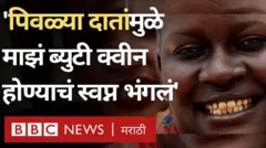 बालपणात फ्लोराईडच्या जास्त संपर्कामुळे दात पिवळे पडून, त्यात खड्डे पडू शकतात