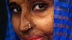 An acid attack survivor