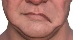 التهاب العصب السابع