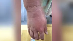Anna's hand with eczema