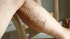 Varicose vein