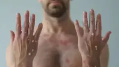 চামড়ায় ঘা নিয়ে একজন পুরুষ।