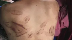 Signs of torture on the back of a man in Kashmir