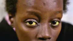 Femme regardant la caméra avec des yeux de jaunisse