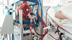 Working ecmo machine in intensive care department