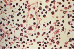 Amostra de linfonodo extraída de um paciente com suspeita de infecção por hantavírus