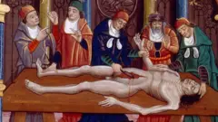 Ilustración medieval de una autopsia realizada en la edad media. Del manuscrito francés "Las propiedades de las cosas" de Bartholomaeus Anglicus, finales del siglo XV.