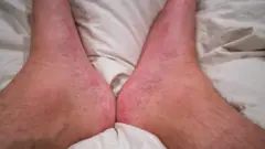 ผู้ป่วยซิฟิลิส จะพบผื่นตามร่างกาย ฝ่ามือ ฝ่าเท้า หรือที่อวัยวะเพศ จากข้อมูลของกรมควบคุมโรค