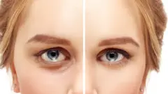 Fotografía compuesta de un primer plano de los ojos de una mujer: a la izquierda se muestra el párpado natural y a la derecha, el párpado definido con una línea más uniforme.
