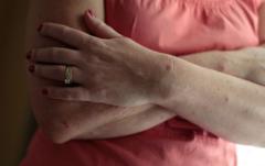 Dərinizdə səpkilər, qaşıntı var? Səbəb stress də ola bilər