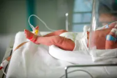 නැනියුලා එකක් සහිත බිළිඳෙකුගේ අතක්