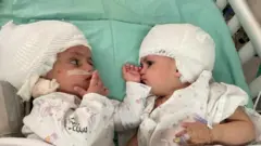 كانت الأختان ملتصقتين بمؤخرة الرأس.