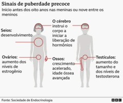 Ilustração gráfica de corpo masculino e feminino, indicando os sinais da puberdade precoce em crianças