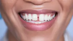 Sonrisa 