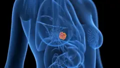 кўкрак бези саратони