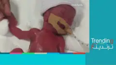 أصغر طفلة في العالم تغادر المستشفى في سنغافورة