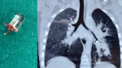 ਮੁੰਡੇ ਦੇ ਫੇਫੜਿਆਂ ਵਿੱਚੋਂ ਕੱਢਿਆ ਗਿਆ ਐਲਈਡੀ ਬਲਬ