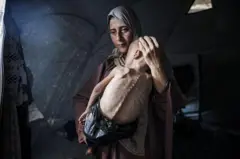 Mulher segura bebê desnutrido