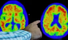 Alzheimer