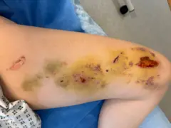 Queimaduras em uma perna 