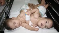 دوقلوهای به‌هم‌چسبیده با موفقیت از هم جدا شدند