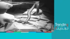  إخراج "ثعبان بحر" من أحشاء رجل