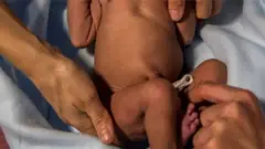 Dokita ati nọọsi n so iwọ ọmọ tuntun ti wọn ṣẹṣẹ bi sile iwosan